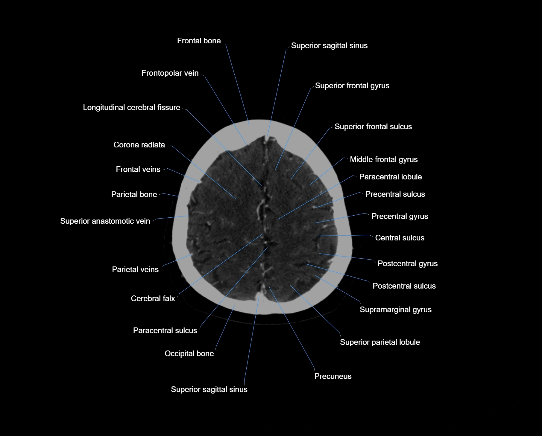CT scan brain axial labelled cross sectional anatomy image-img-000057.webp